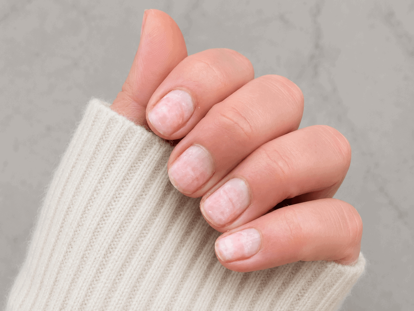 Close-up of yellow stained nails before treatment