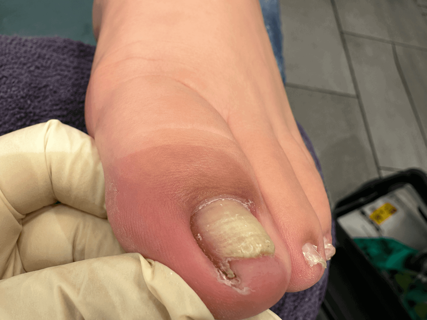 Close-up of an ingrown toenail on the big toe